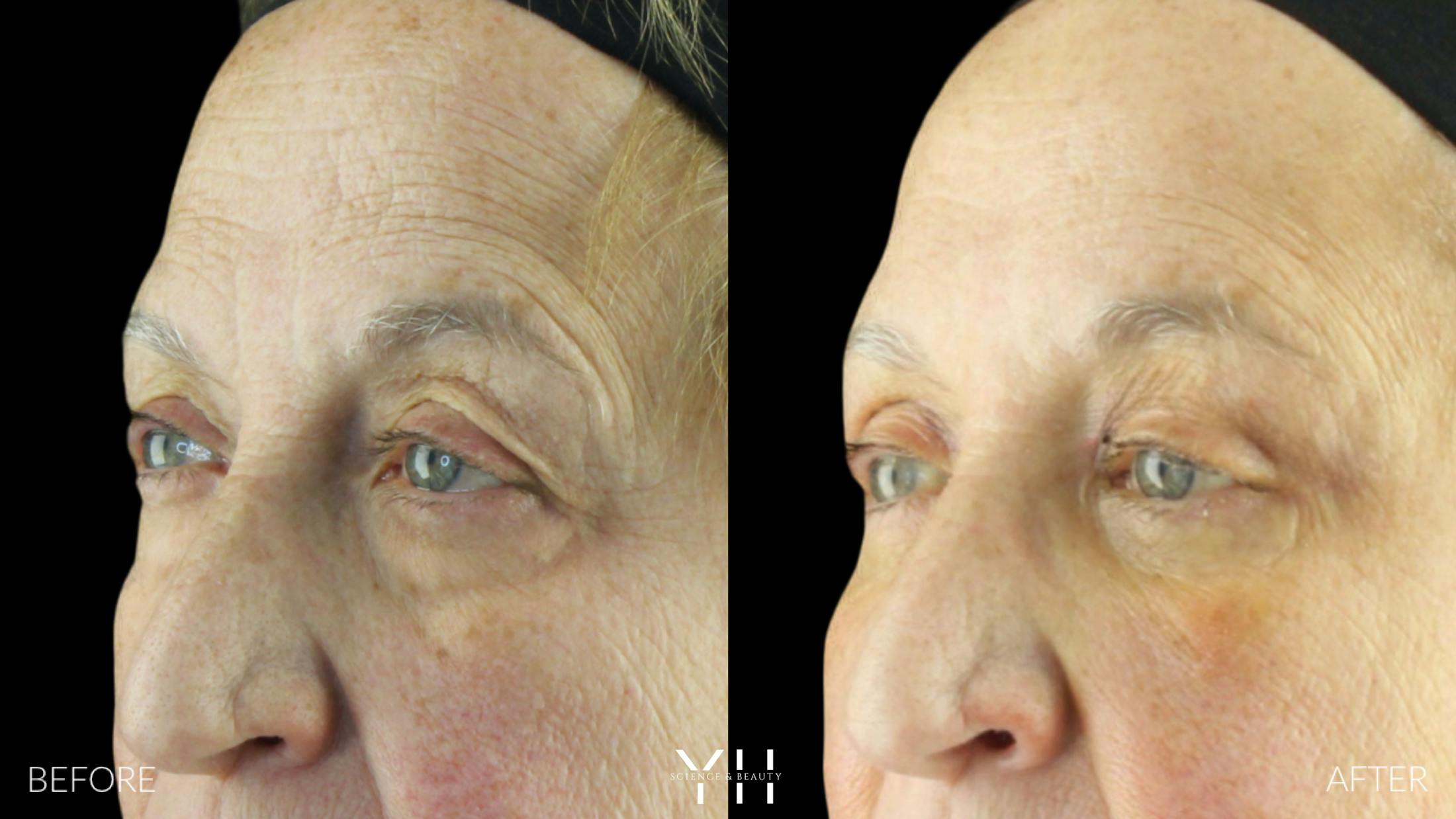 Brow Lift Before & After Gallery - Patient 421725 - Image 4