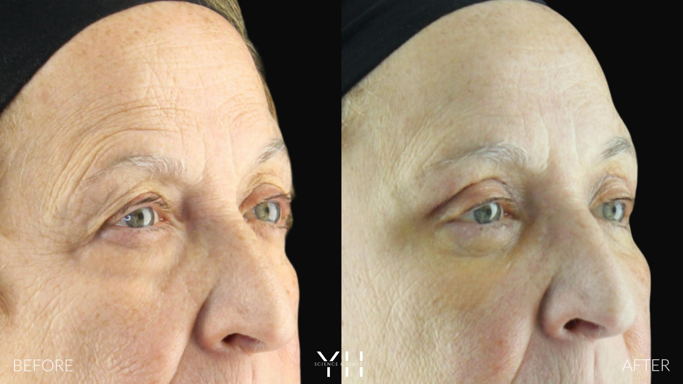 Brow Lift Before & After Gallery - Patient 421725 - Image 2