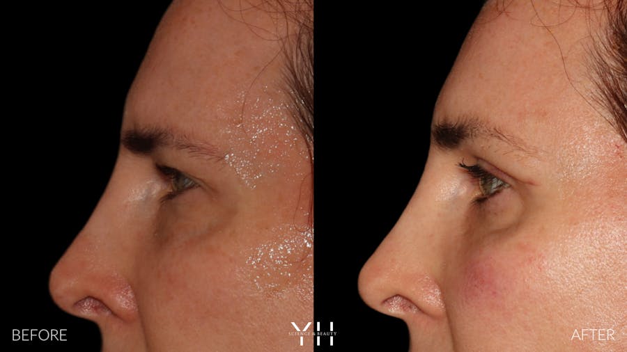 Brow Lift Before & After Gallery - Patient 843689 - Image 5
