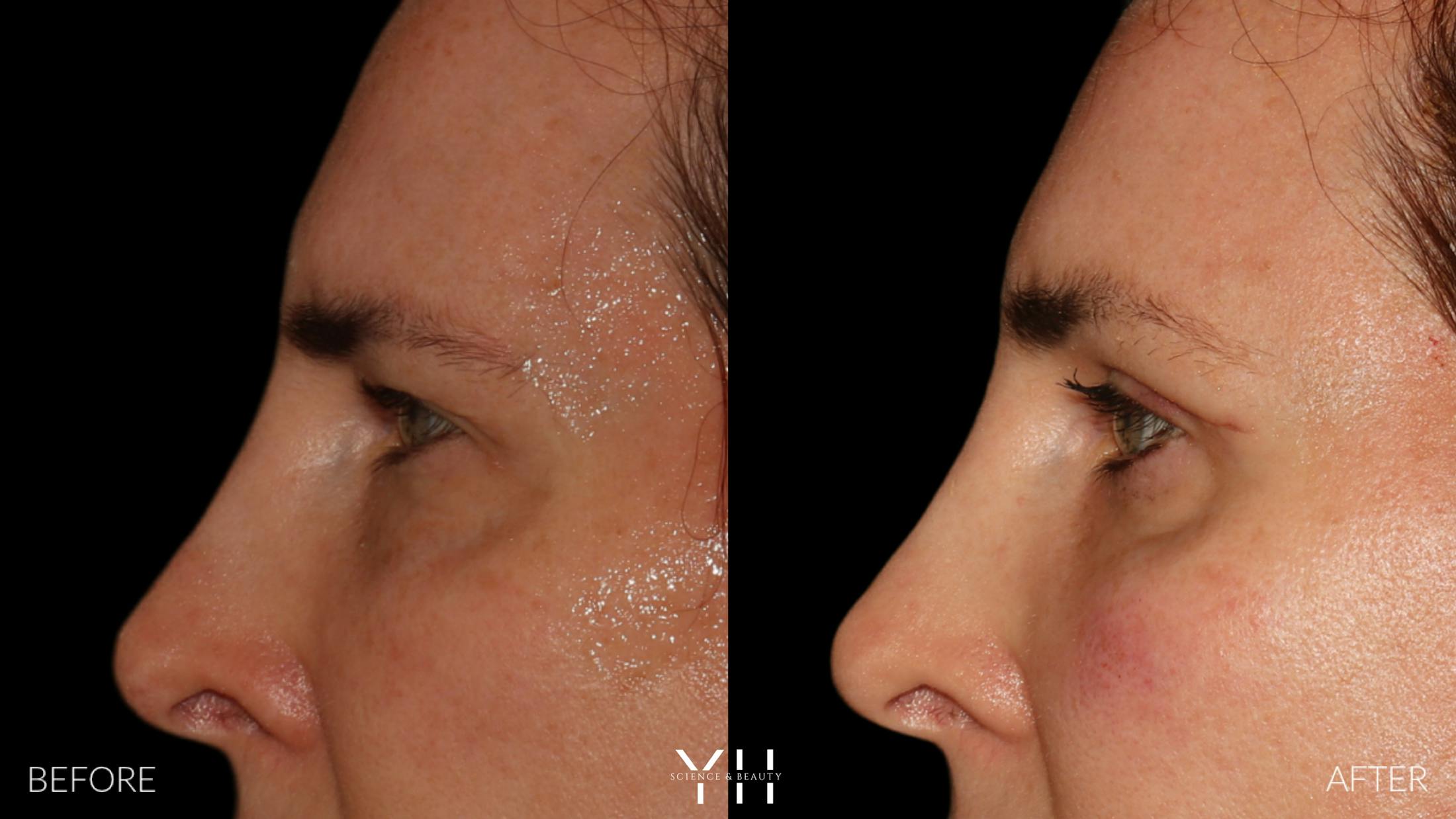 Brow Lift Before & After Gallery - Patient 843689 - Image 5