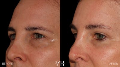 Brow Lift Before & After Gallery - Patient 843689 - Image 4