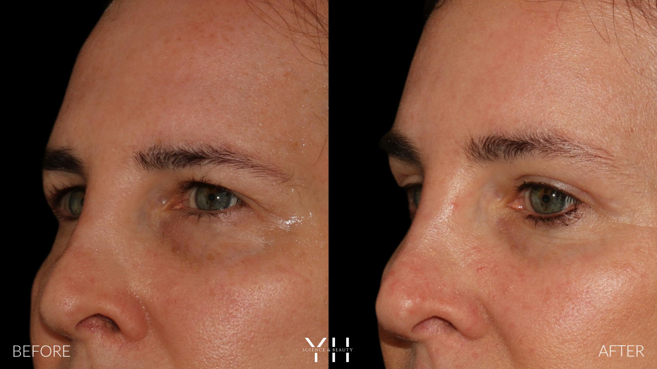 Brow Lift Before & After Gallery - Patient 843689 - Image 4