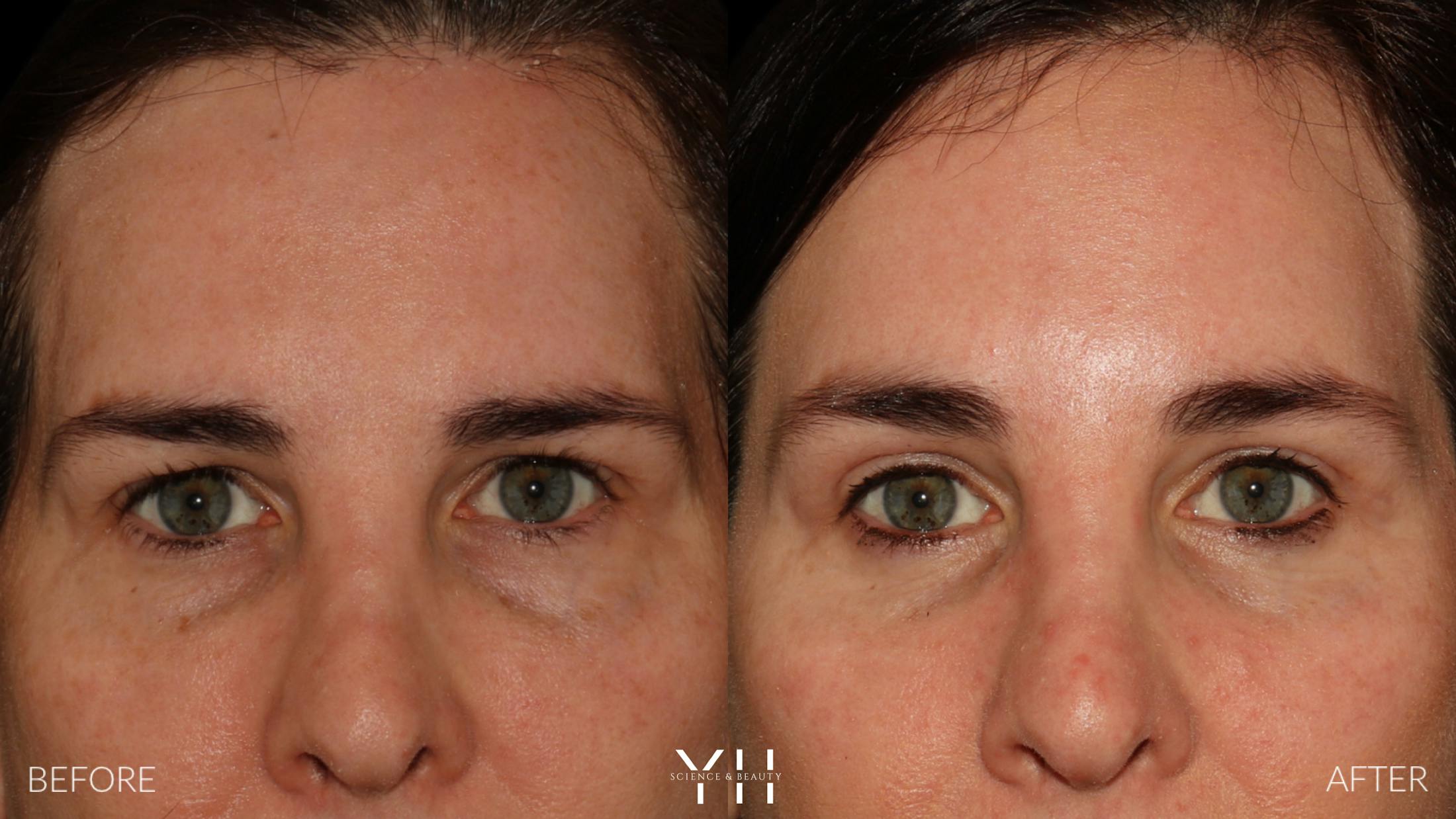 Brow Lift Before & After Gallery - Patient 843689 - Image 1