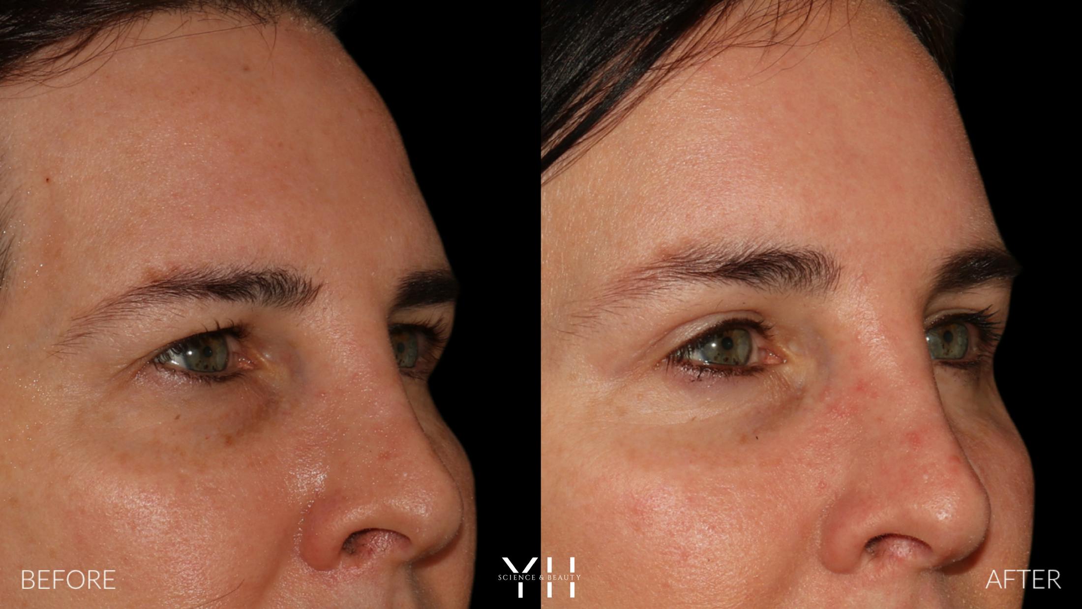 Brow Lift Before & After Gallery - Patient 843689 - Image 2