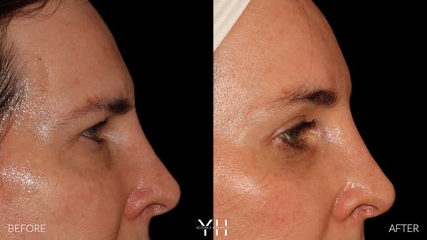 Brow Lift Before & After Gallery - Patient 843689 - Image 3