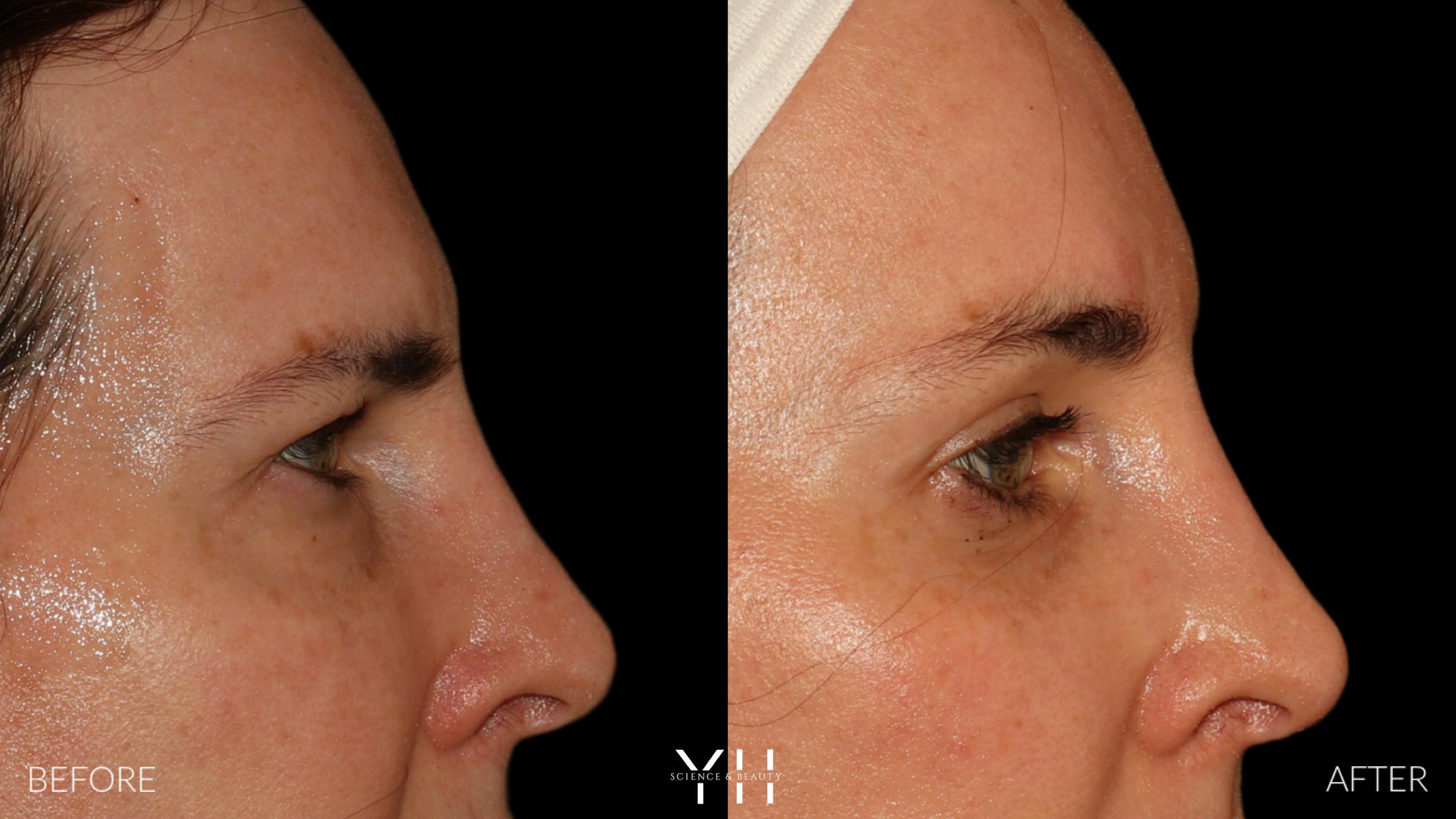 Brow Lift Before & After Gallery - Patient 843689 - Image 3