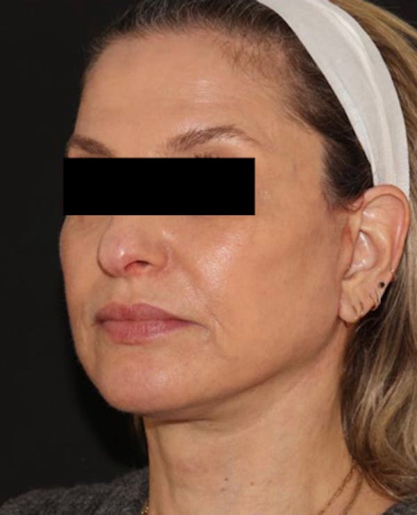 Facelift Before & After Gallery - Patient 319082 - Image 4