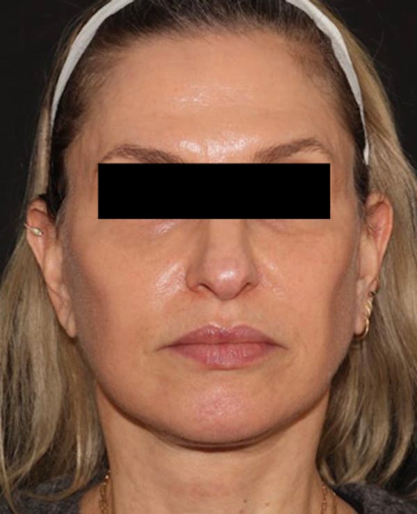 Facelift Before & After Gallery - Patient 319082 - Image 2