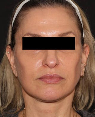 Facelift Before & After Gallery - Patient 319082 - Image 2