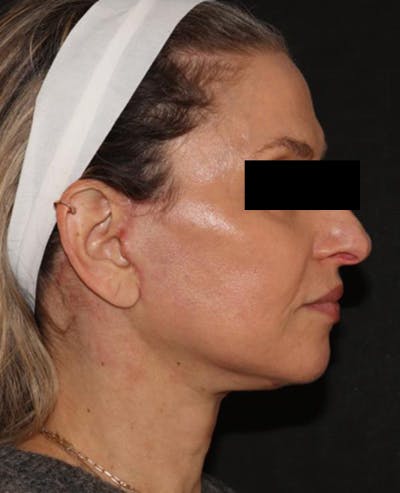 Facelift Before & After Gallery - Patient 319082 - Image 6