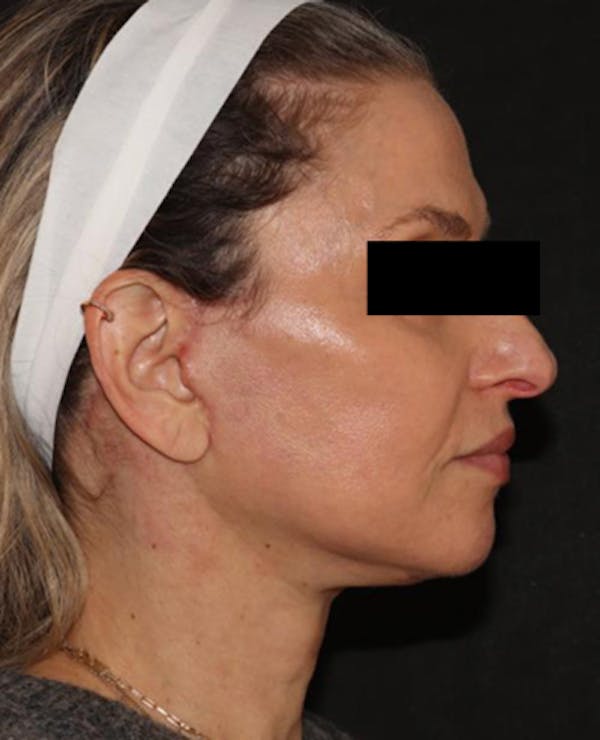 Facelift Before & After Gallery - Patient 319082 - Image 6