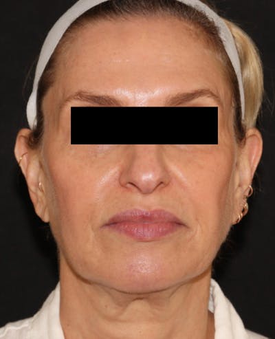 Facelift Before & After Gallery - Patient 319082 - Image 1