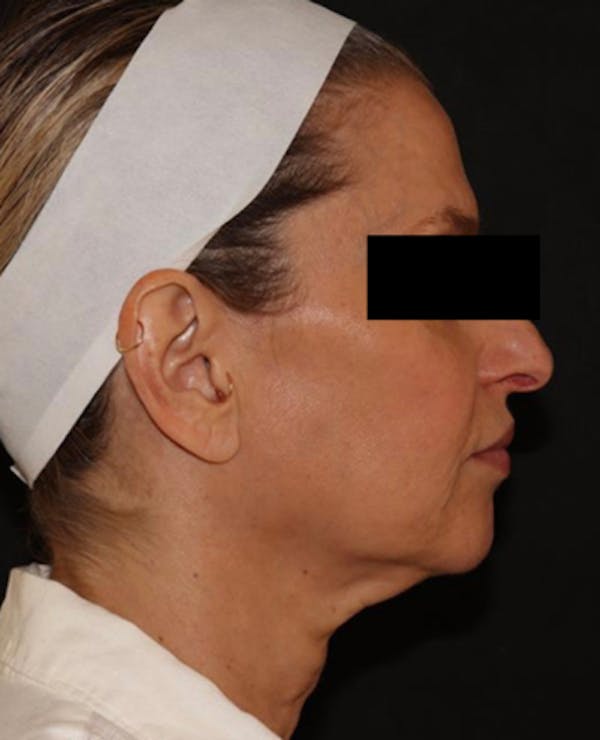 Facelift Before & After Gallery - Patient 319082 - Image 5