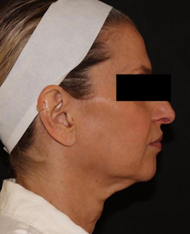 Facelift Before & After Gallery - Patient 319082 - Image 5