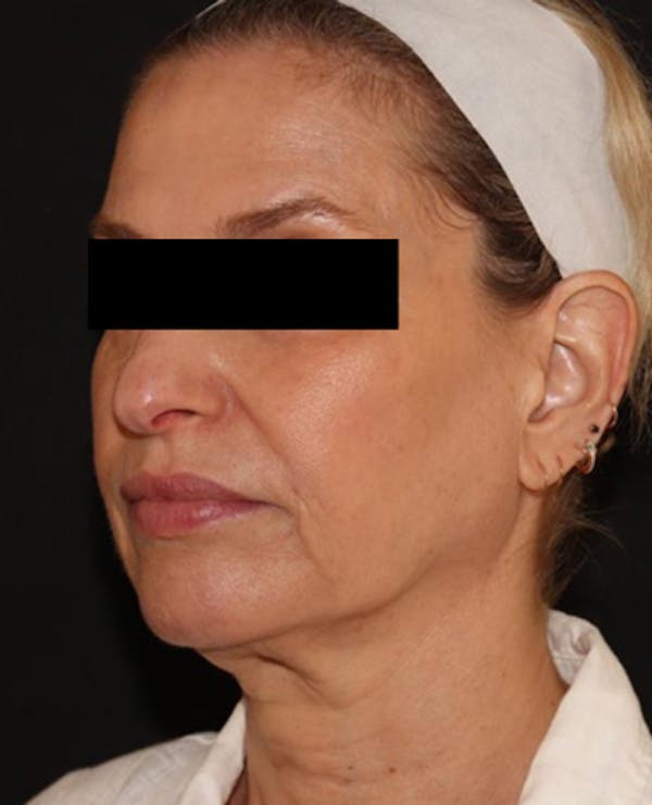 Facelift Before & After Gallery - Patient 319082 - Image 3