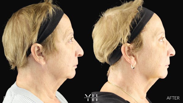  Blepharoplasty Before & After Gallery - Patient 278366 - Image 8
