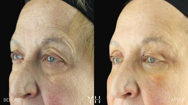  Blepharoplasty Before & After Gallery - Patient 278366 - Image 3