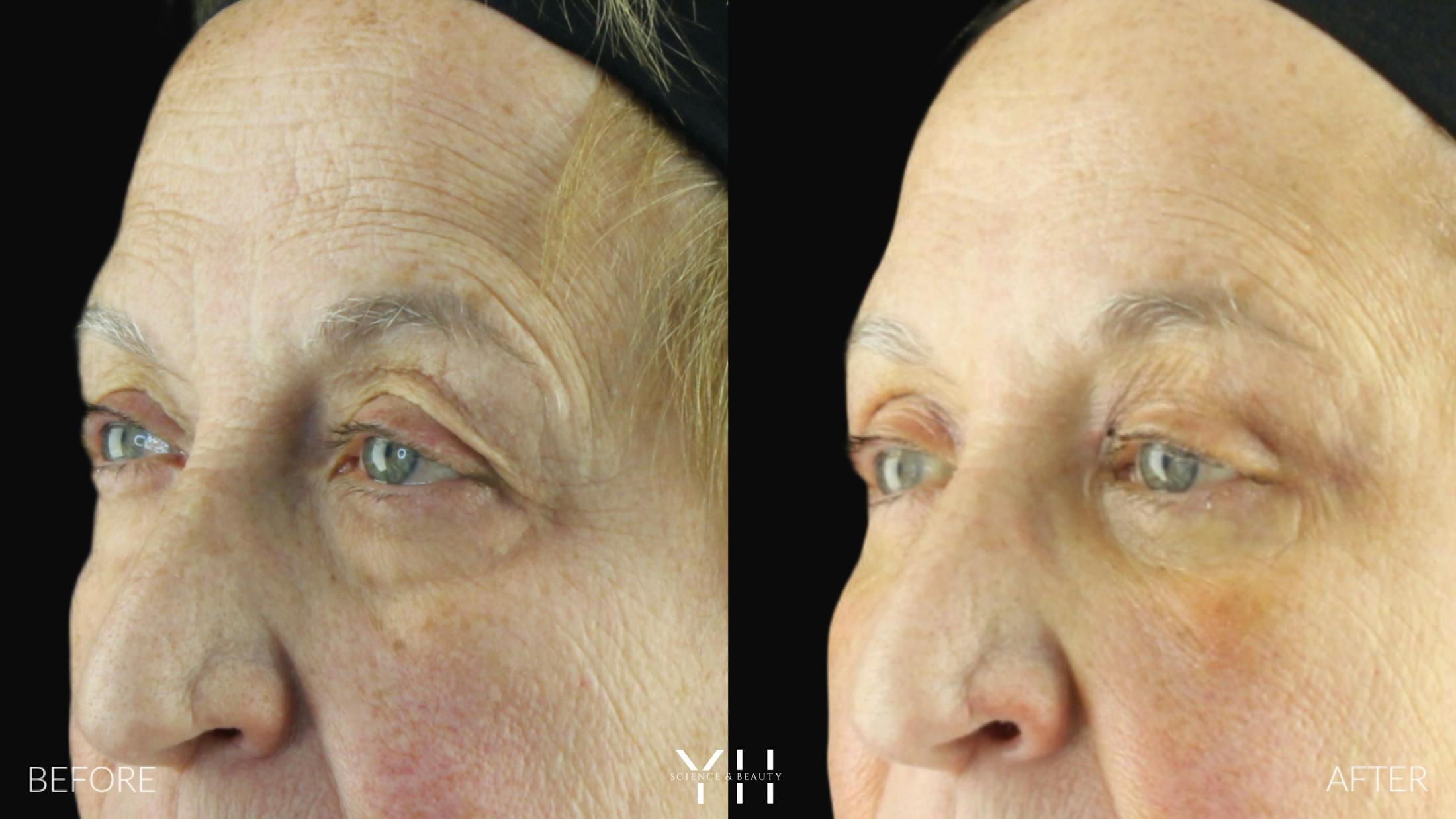 Blepharoplasty Before & After Gallery - Patient 278366 - Image 3