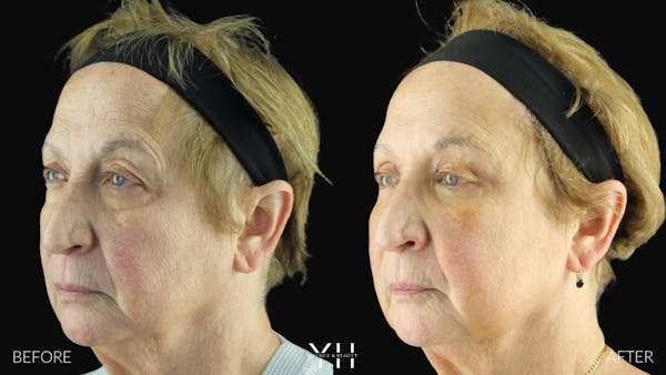  Blepharoplasty Before & After Gallery - Patient 278366 - Image 9