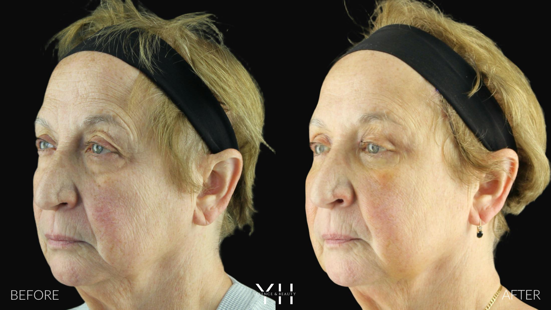 Blepharoplasty Before & After Gallery - Patient 278366 - Image 9