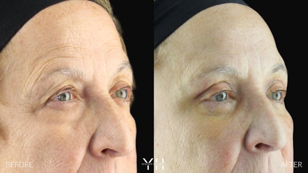  Blepharoplasty Before & After Gallery - Patient 278366 - Image 2