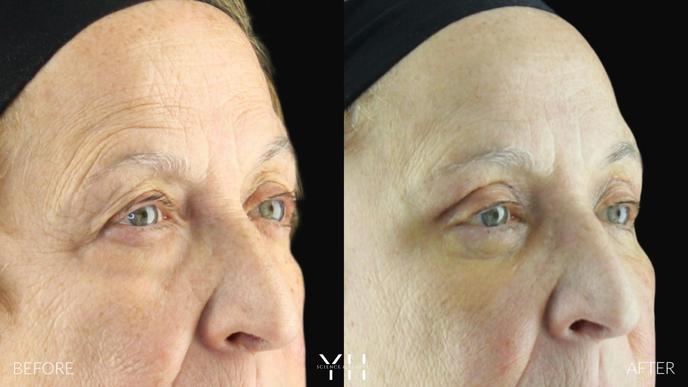Blepharoplasty Before & After Gallery - Patient 278366 - Image 2