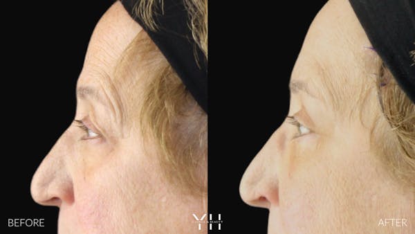  Blepharoplasty Before & After Gallery - Patient 278366 - Image 5