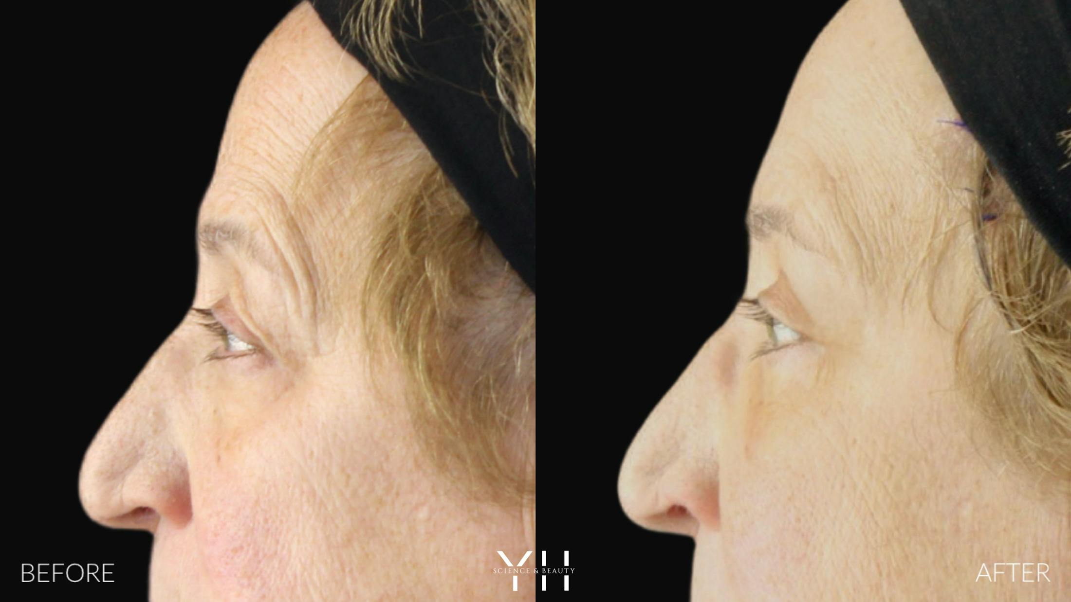 Blepharoplasty Before & After Gallery - Patient 278366 - Image 5