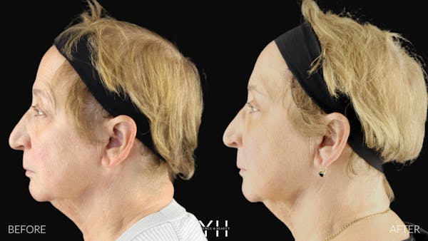  Blepharoplasty Before & After Gallery - Patient 278366 - Image 10