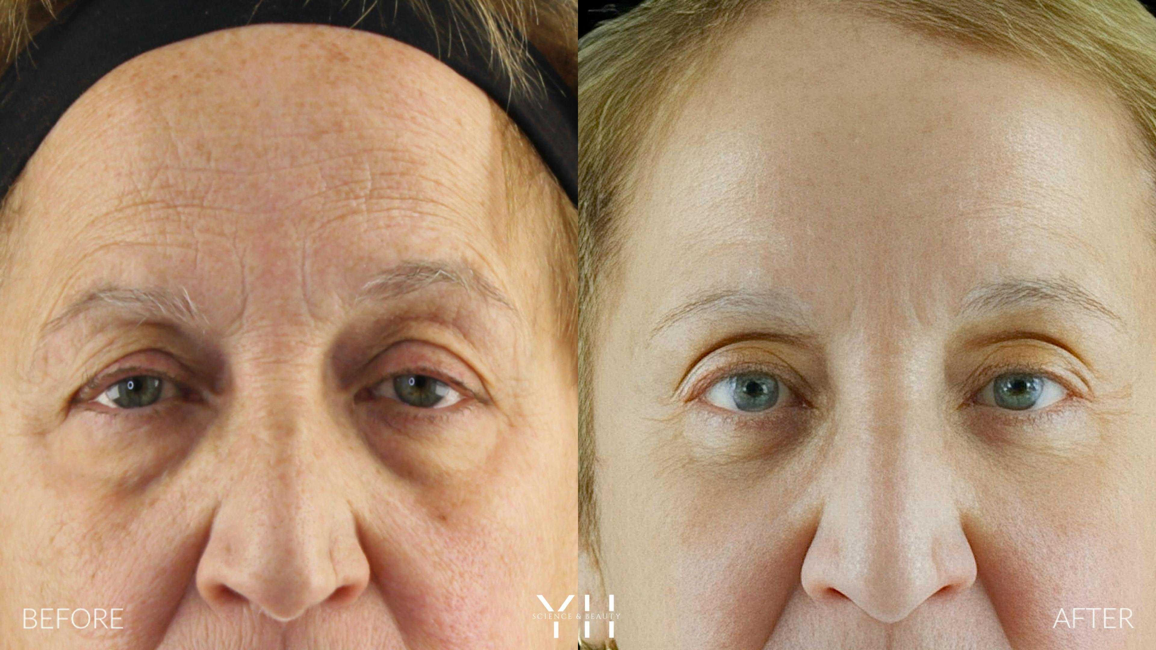 Before and After Eyelid Surgery