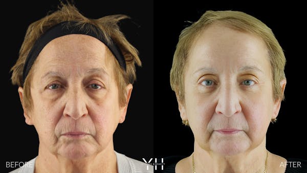  Blepharoplasty Before & After Gallery - Patient 278366 - Image 6