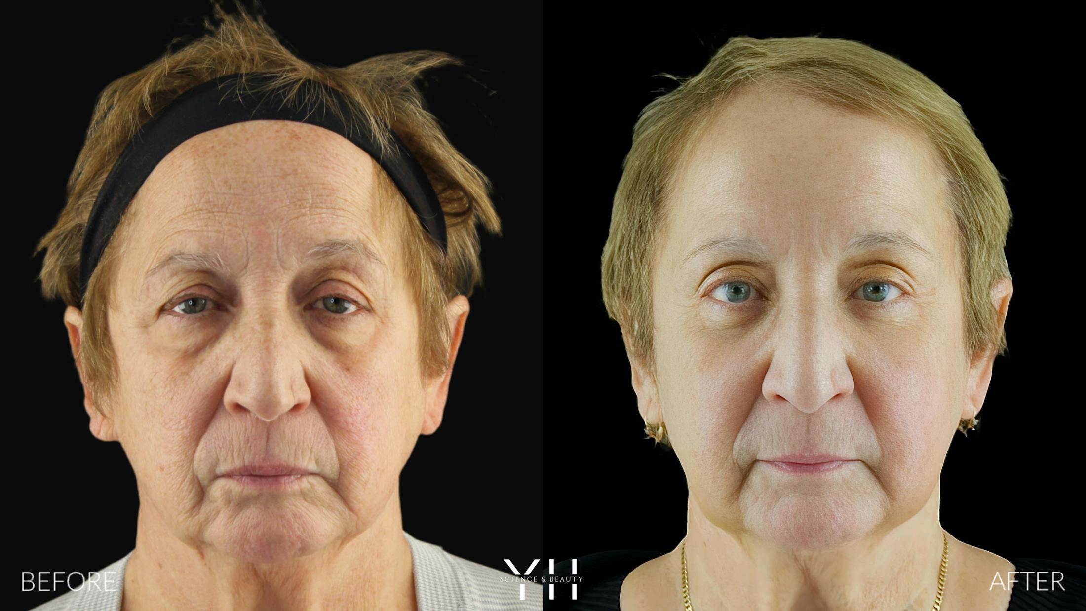 Blepharoplasty Before & After Gallery - Patient 278366 - Image 6