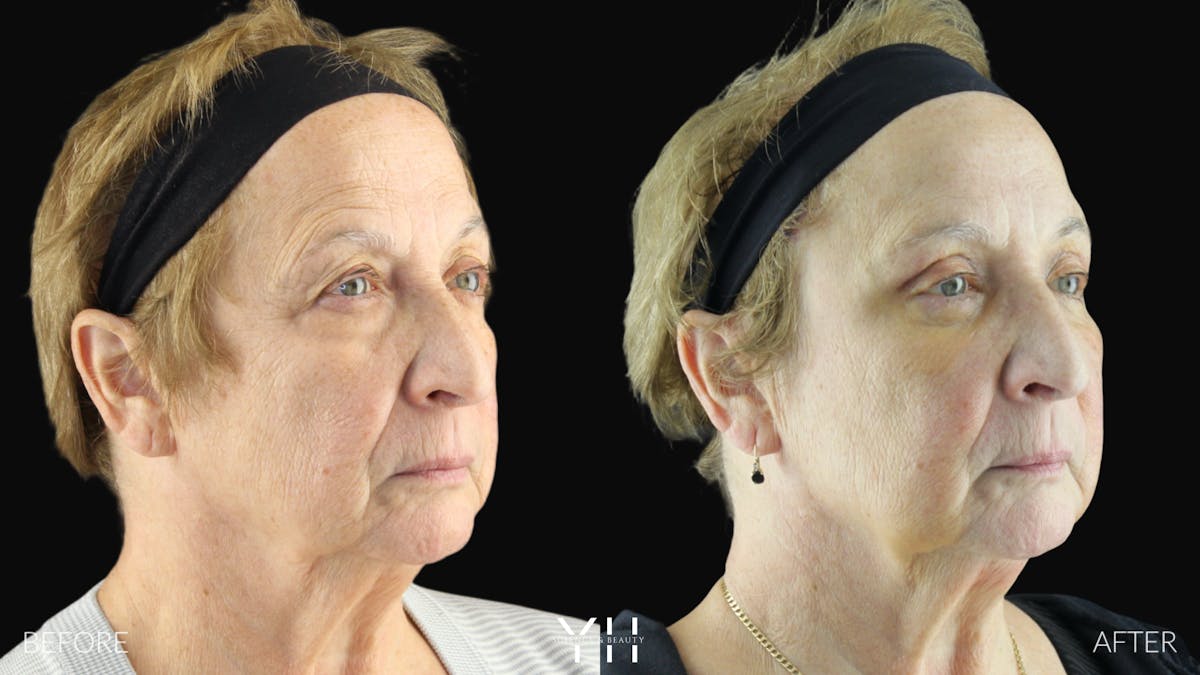  Blepharoplasty Before & After Gallery - Patient 278366 - Image 7