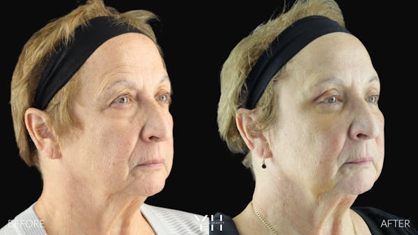  Blepharoplasty Before & After Gallery - Patient 278366 - Image 7