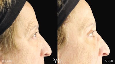  Blepharoplasty Before & After Gallery - Patient 278366 - Image 4