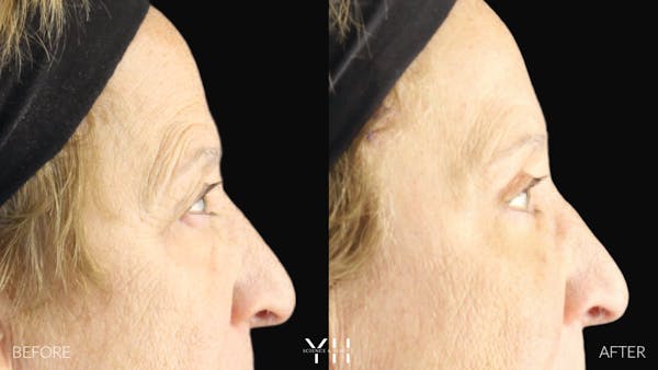  Blepharoplasty Before & After Gallery - Patient 278366 - Image 4