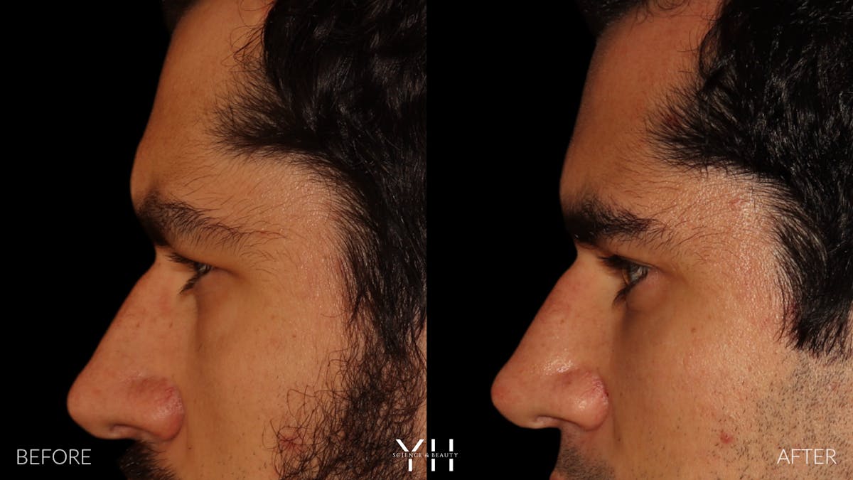  Blepharoplasty Before & After Gallery - Patient 950867 - Image 4