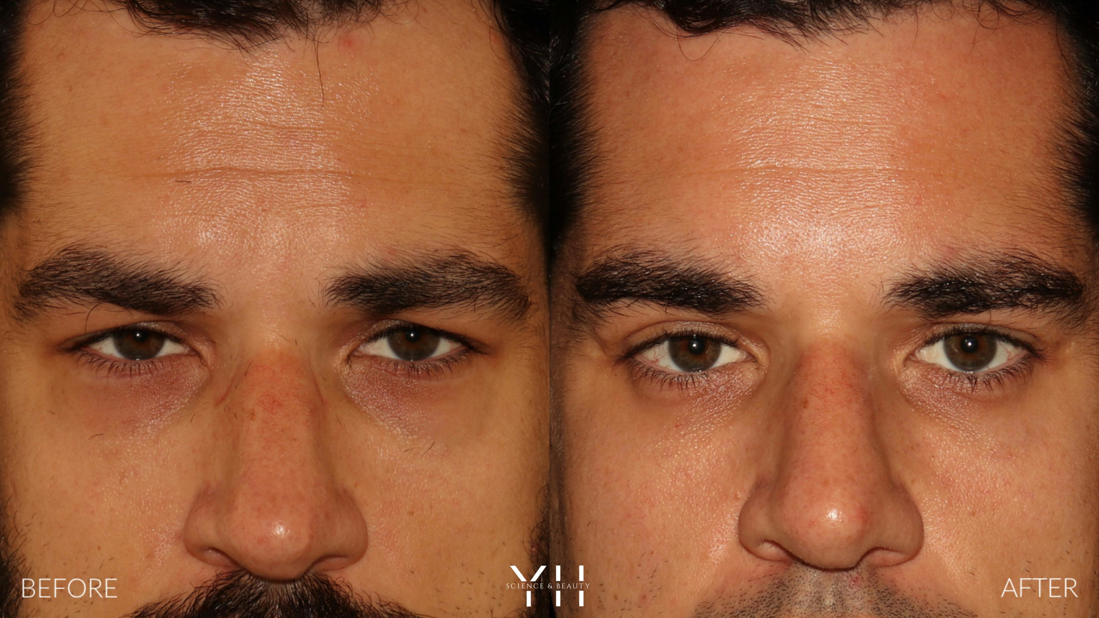 Before and After Eyelid Surgery