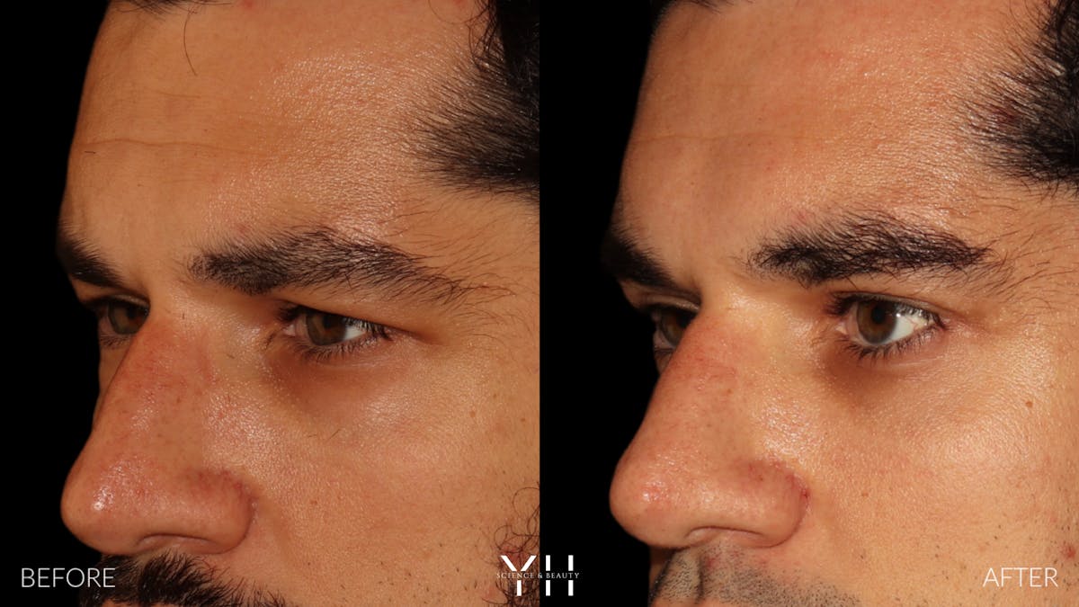  Blepharoplasty Before & After Gallery - Patient 950867 - Image 5