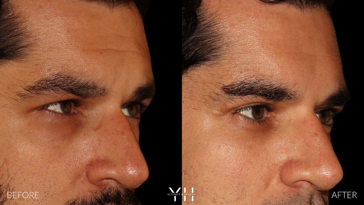  Blepharoplasty Before & After Gallery - Patient 950867 - Image 2