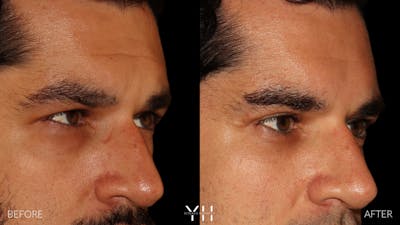  Blepharoplasty Before & After Gallery - Patient 950867 - Image 2