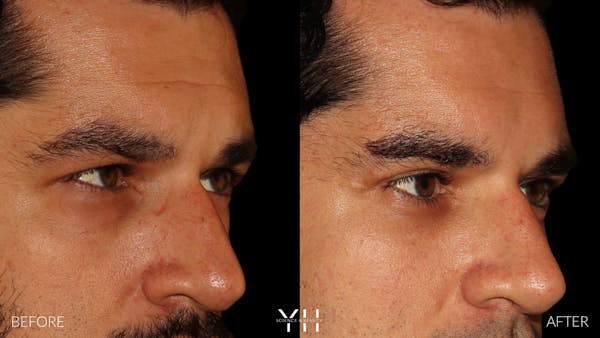  Blepharoplasty Before & After Gallery - Patient 950867 - Image 2