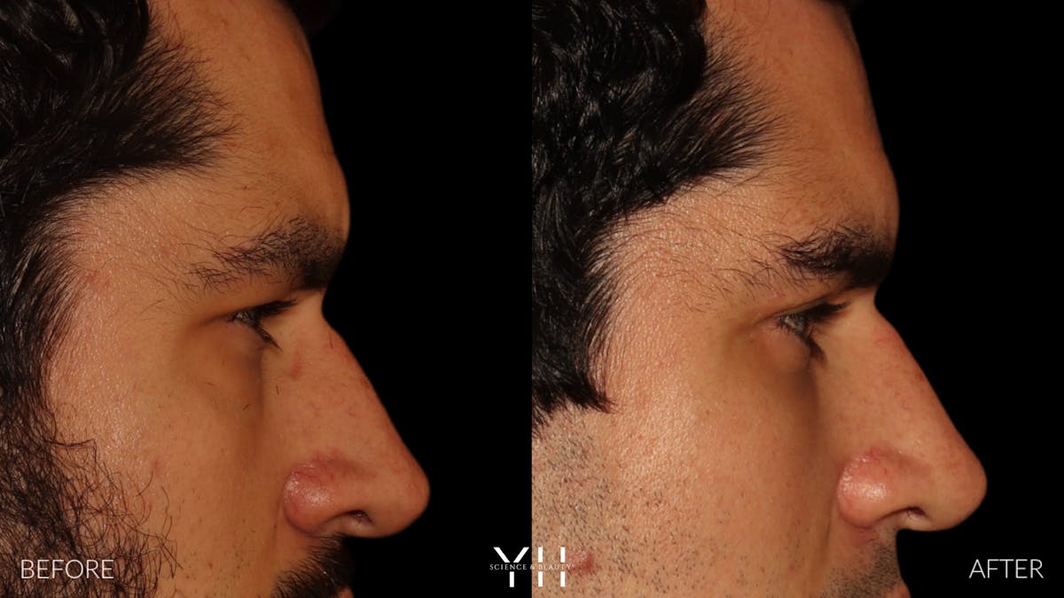  Blepharoplasty Before & After Gallery - Patient 950867 - Image 3