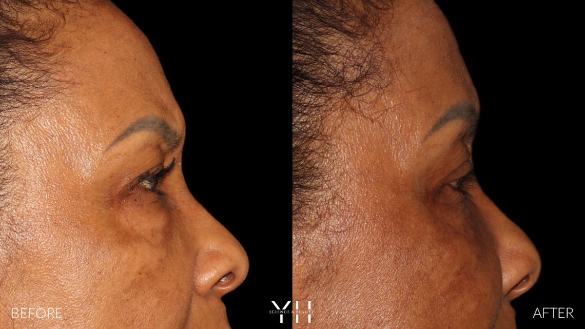  Blepharoplasty Before & After Gallery - Patient 323099 - Image 4