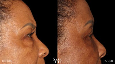  Blepharoplasty Before & After Gallery - Patient 323099 - Image 4