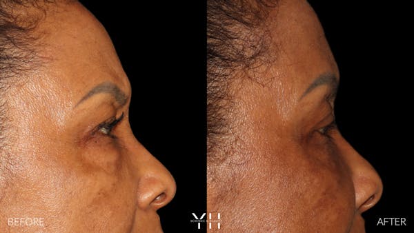  Blepharoplasty Before & After Gallery - Patient 323099 - Image 4