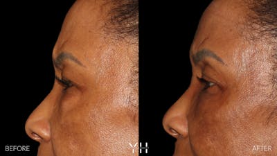  Blepharoplasty Before & After Gallery - Patient 323099 - Image 6