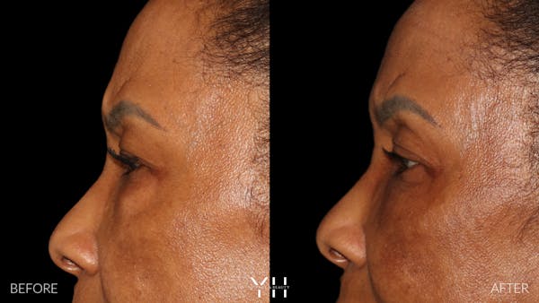  Blepharoplasty Before & After Gallery - Patient 323099 - Image 6