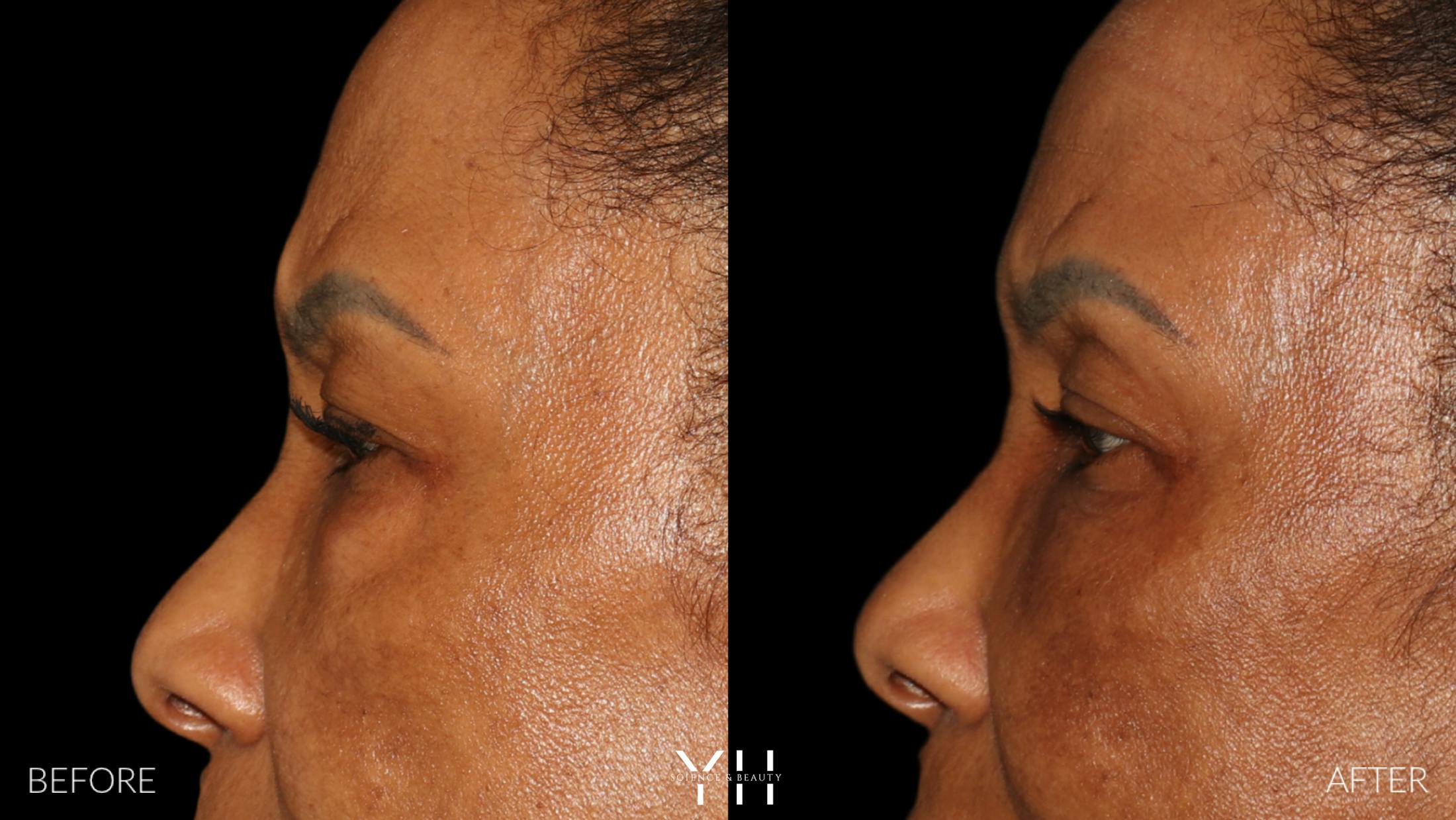 Blepharoplasty Before & After Gallery - Patient 323099 - Image 6