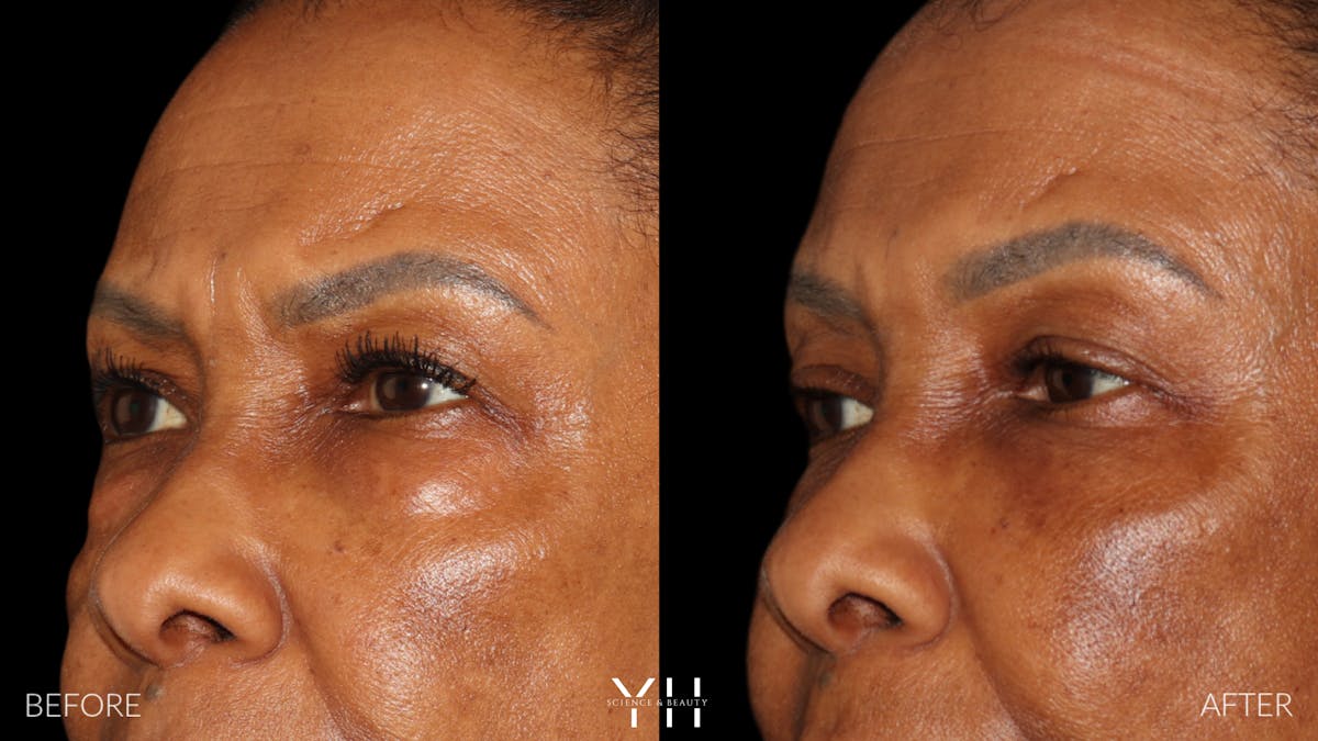  Blepharoplasty Before & After Gallery - Patient 323099 - Image 5